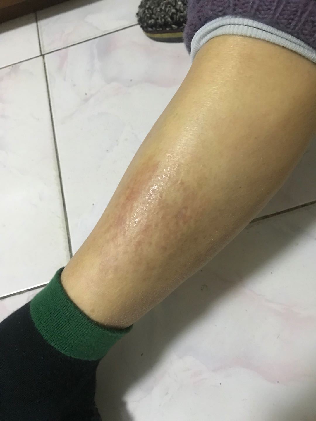 复方丙酸氯倍他索临床应用心得_神经性皮炎_神经性皮炎治疗方式 - 好