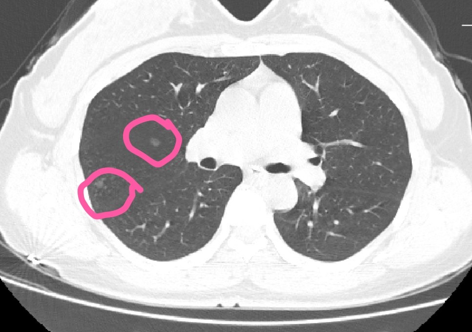 肺部结节 肺部结节