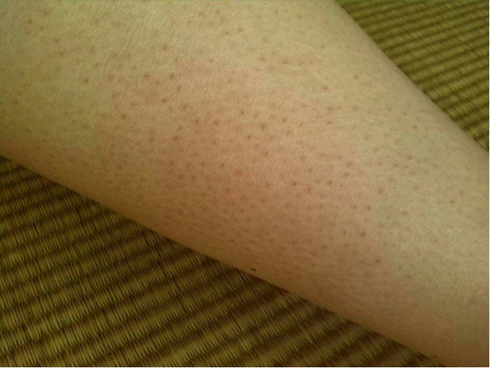 果酸换肤治疗鸡皮肤效果(鸡皮肤果酸换肤做几次有效果) 果酸换肤治疗鸡皮肤效果(鸡皮肤果酸换肤做几次有效果)