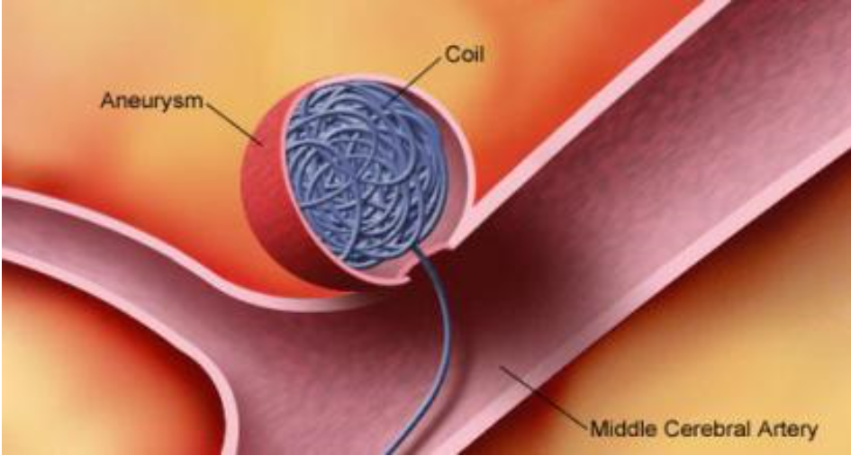 颅内动脉瘤选择介入栓塞还是开颅夹闭治疗?答案很简单