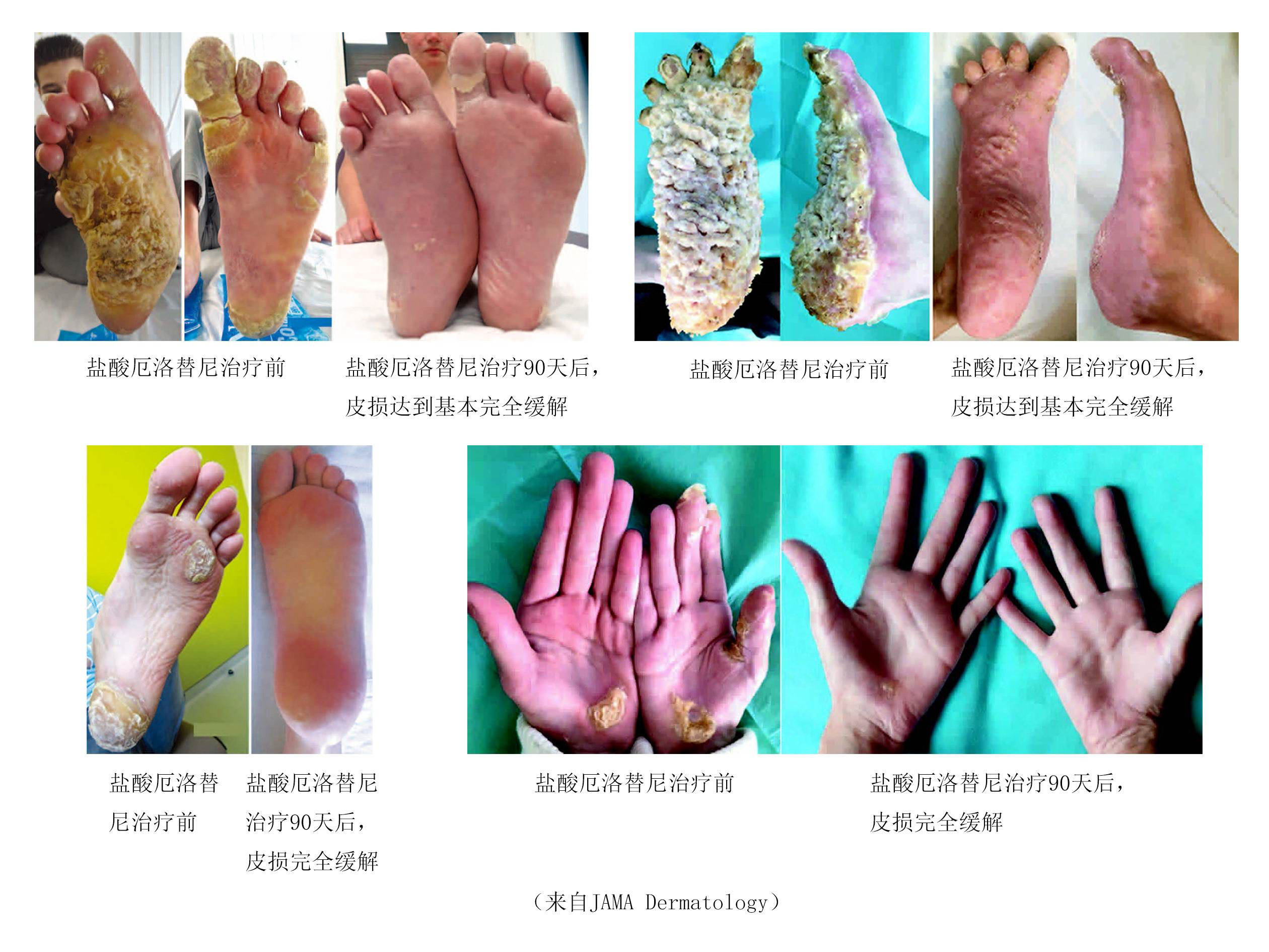 手足角质硬化症图片图片