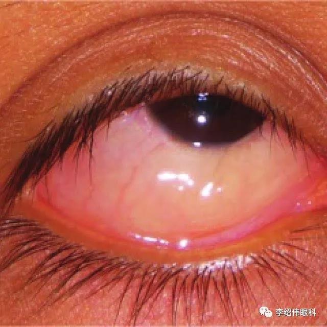 新冠肺炎眼睛红图片