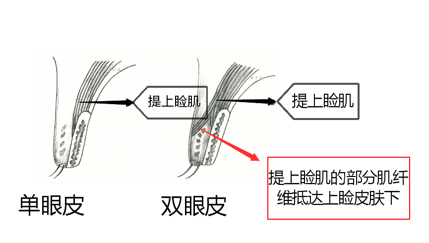 倘若提上睑肌发育不好,部分纤维没能穿过眼轮匝肌,没有附着于睑缘上方