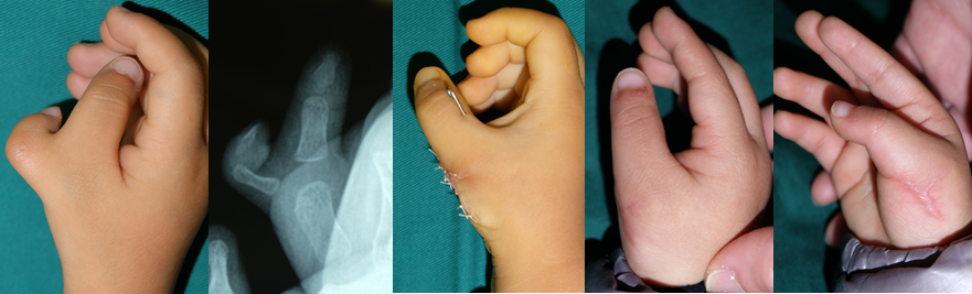 多指畸形概述(大量手术实例!)_多指畸形_介绍_治疗方式 - 好大夫在线