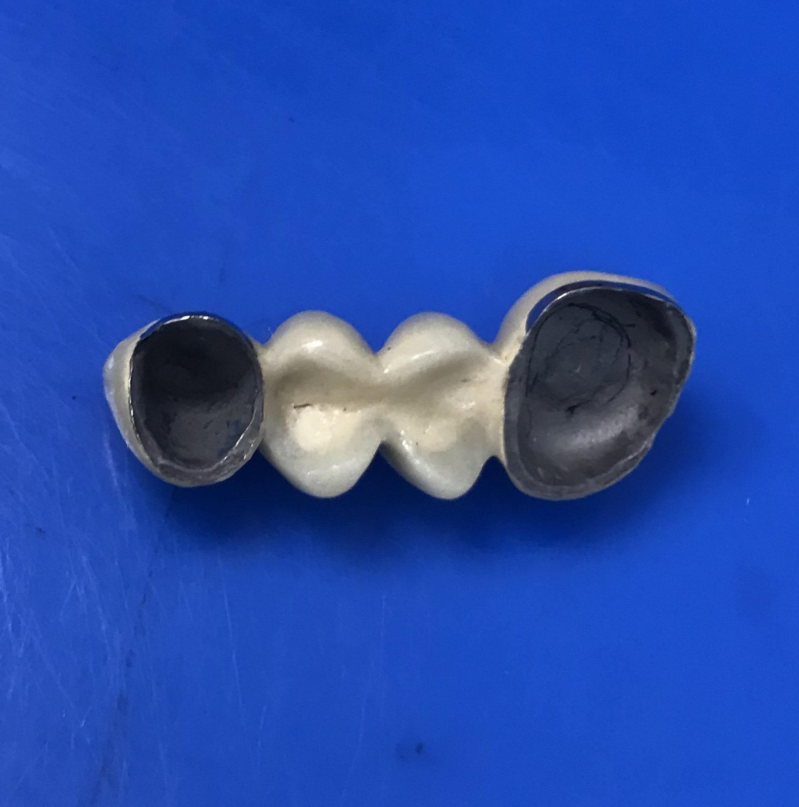 一般做的牙冠要比缺少的牙齿要多两颗固定桥,需要将两边正常牙齿磨小