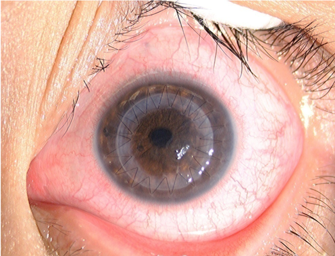 圆锥角膜——之急性角膜水肿_圆锥角膜_介绍_症状表现_检查_治疗方式