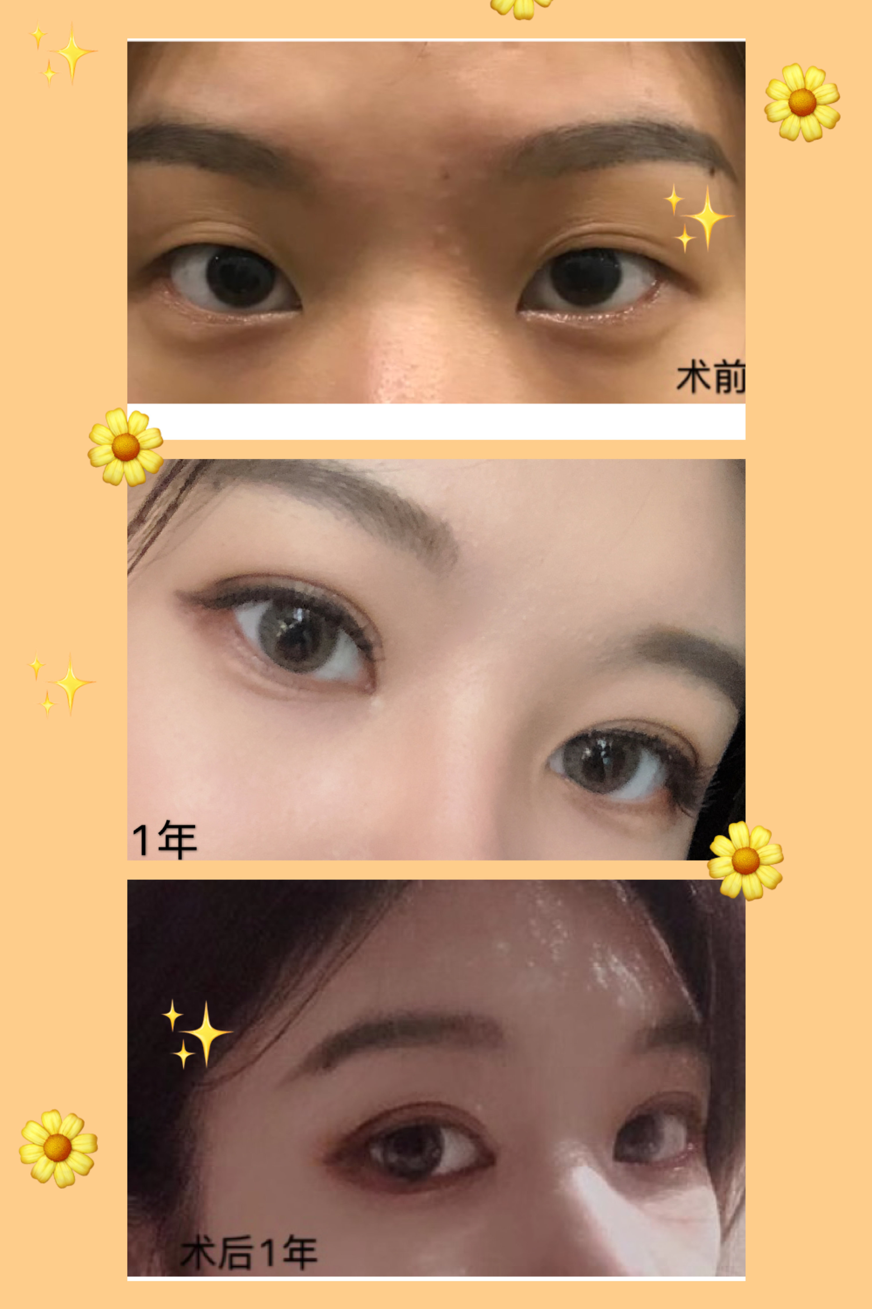 分享一些术前,术后对比照_双眼皮手术_双眼皮手术治疗介绍 - 好大夫