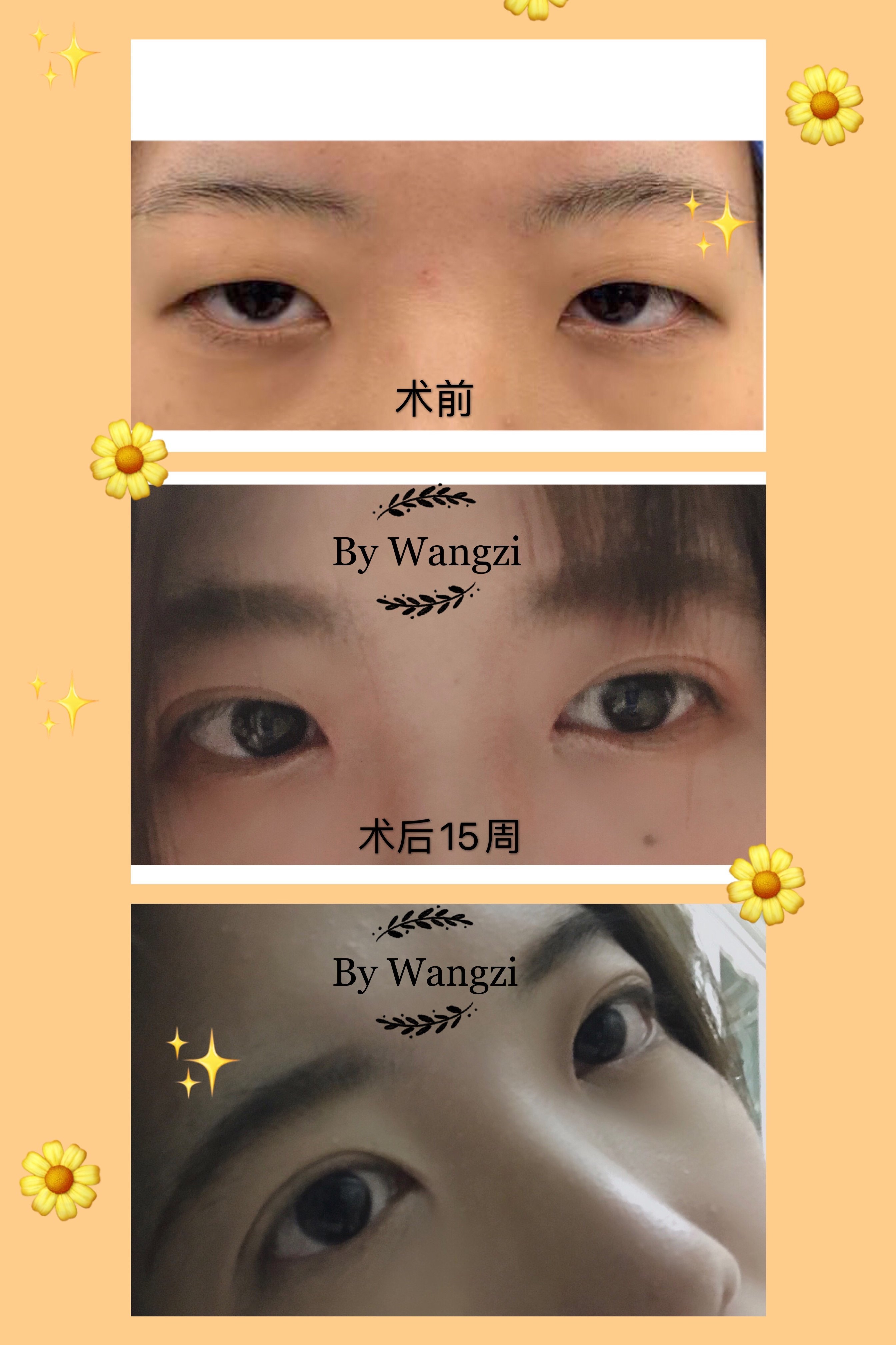 分享一些术前,术后对比照_双眼皮手术_双眼皮手术治疗介绍 - 好大夫