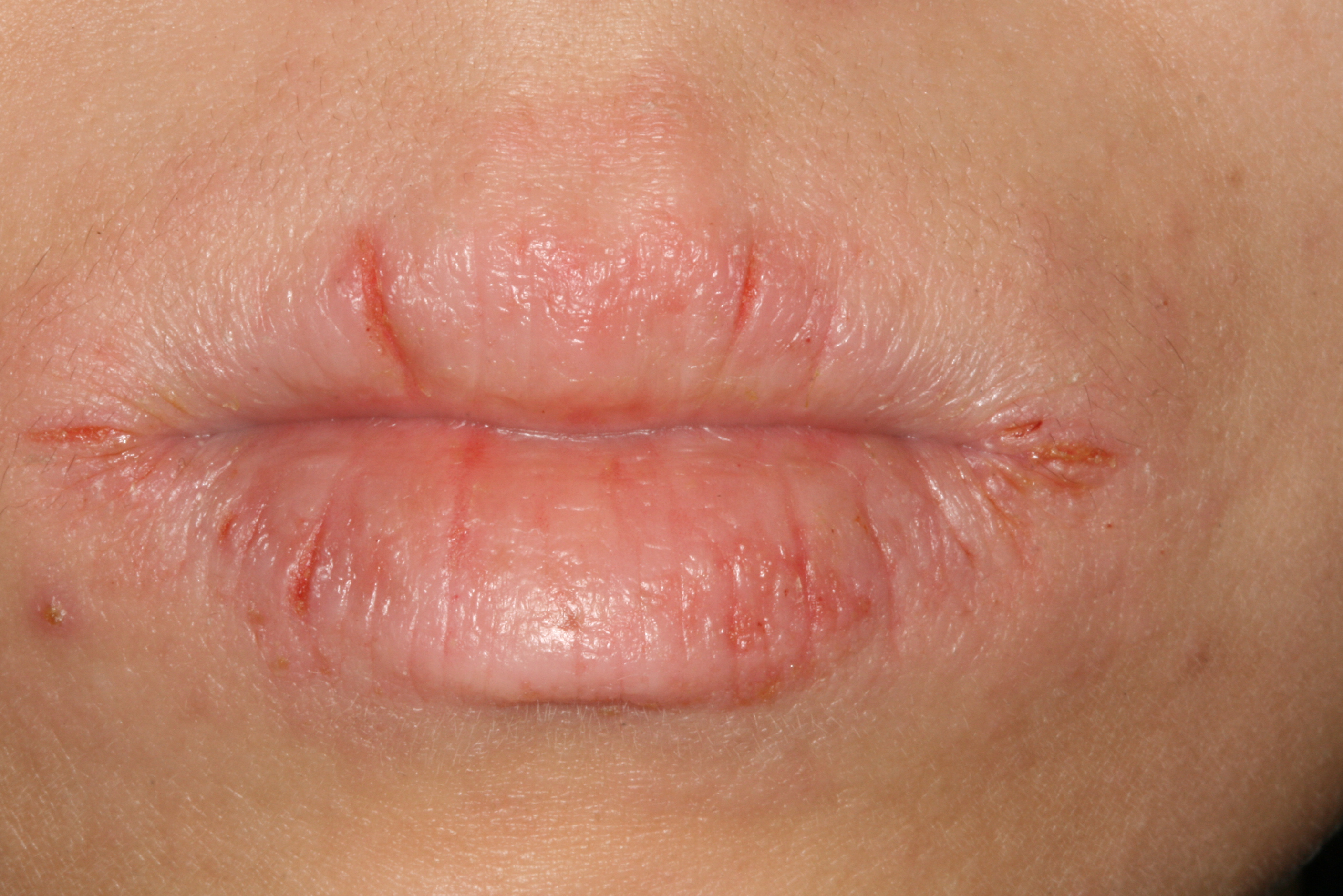 口腔扁平苔藓复发性阿弗他溃疡由于科普教育相对不足,因此患者对口腔