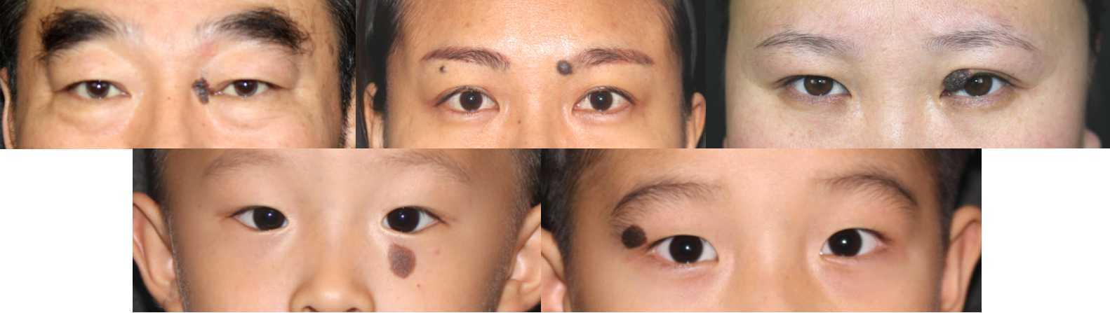 若黑痣较大或位于眼睑,睑缘,眉毛周围,切除后会牵拉或破坏局部结构时