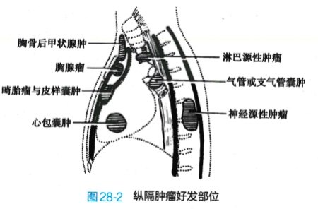 纵隔肿瘤及其治疗原则_纵隔肿瘤_纵隔肿瘤相关疾病 - 好大夫在线