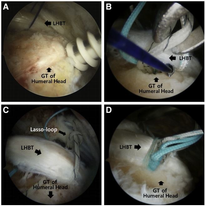 首先在合适的位置置入一枚带线锚钉.