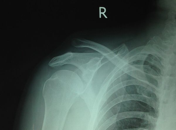 18 高绪仁的肩锁关节脱位损伤患者x片jpg