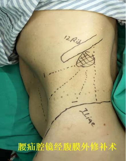 腹外疝的前世今生_腹外疝_介绍_治疗方式 - 好大夫在线