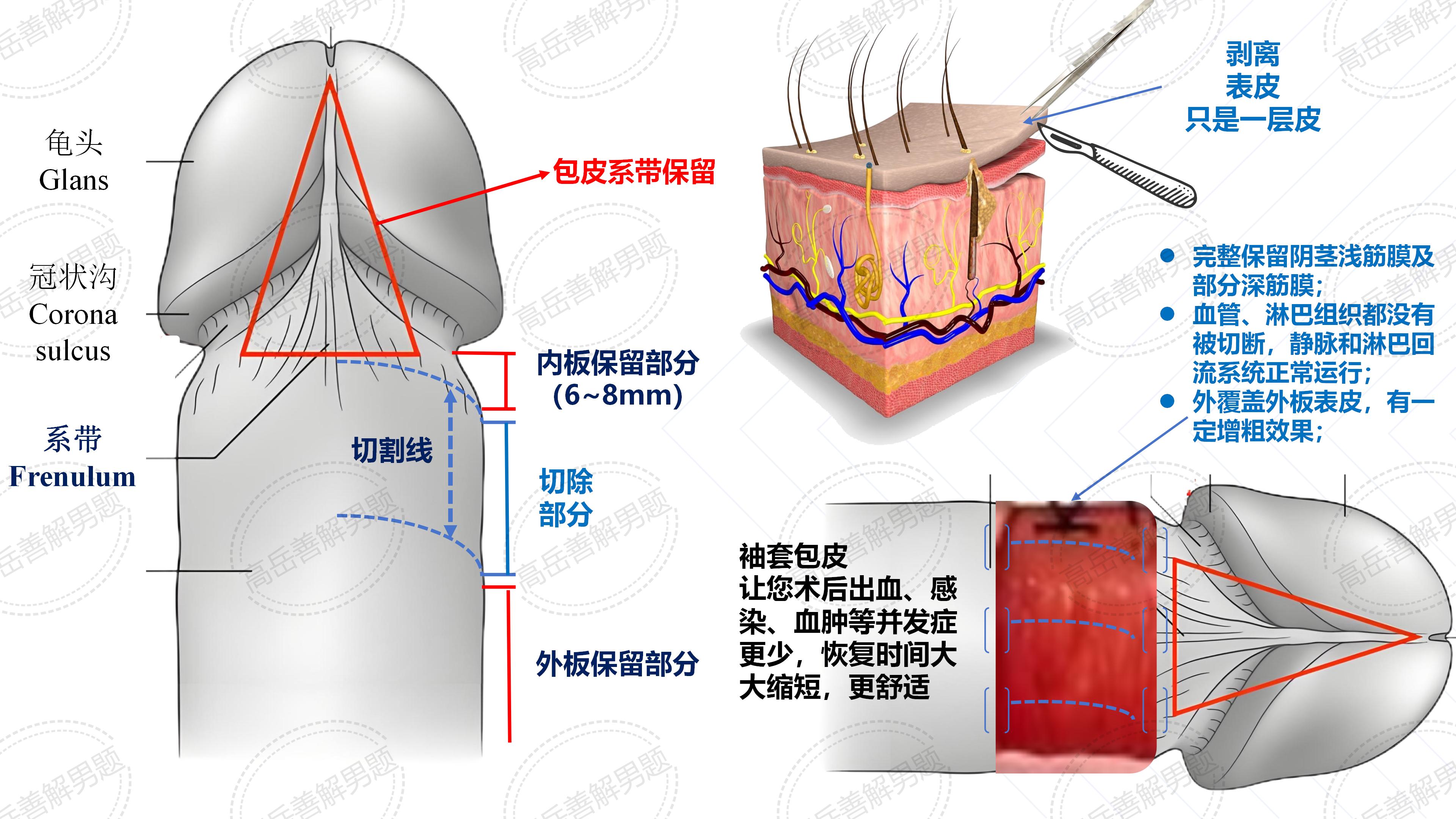"袖套式"包皮环切手术恢复时间轴,让你心里有底