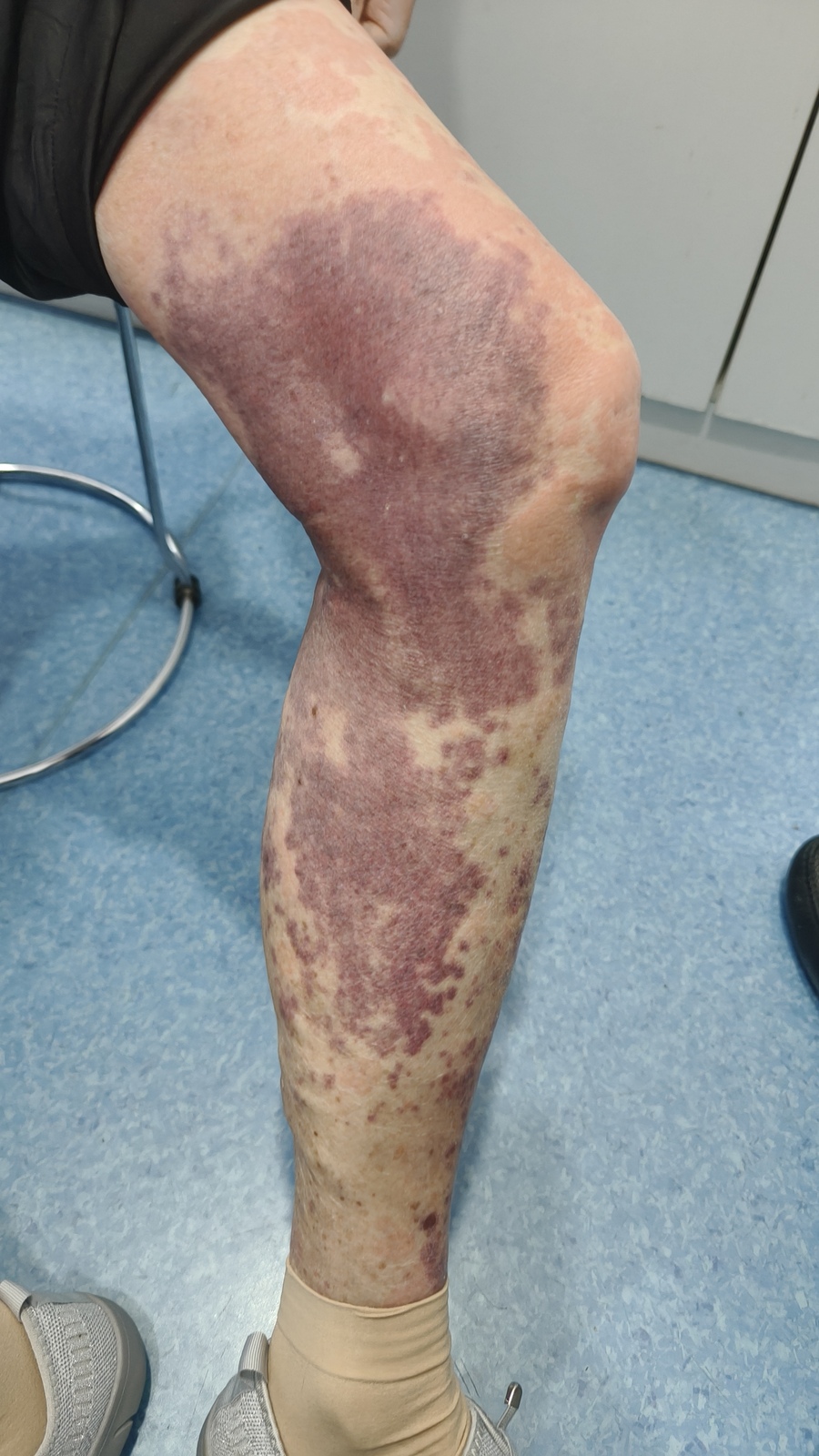 过敏性紫癜病因发病机制 和临床表现