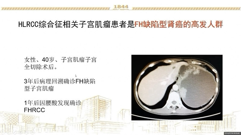 FH缺陷型子宫肌瘤与肾癌2