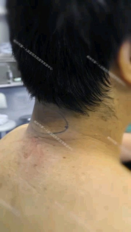 富贵包”，是颈后皮下脂肪筋膜组织增厚堆积而成，微创旋切吸除，是目前最有效的方法，损伤小，几乎不出血。