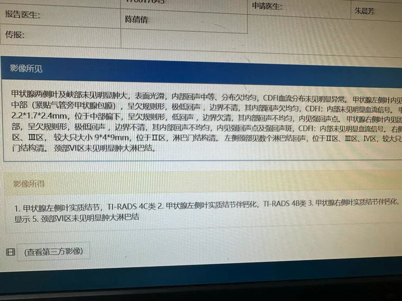 双侧甲状腺癌热消融术后，一年，为患者开心！