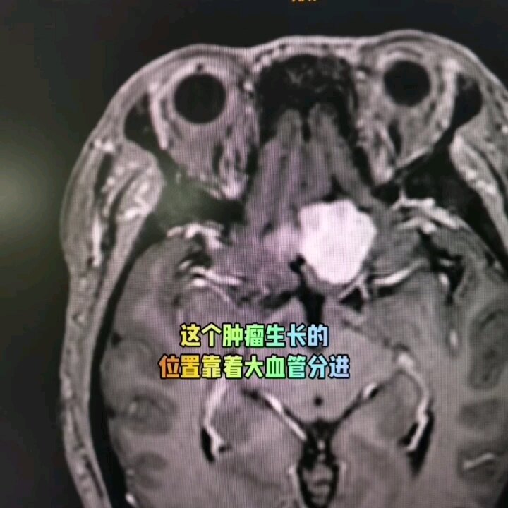 颅底脑膜瘤