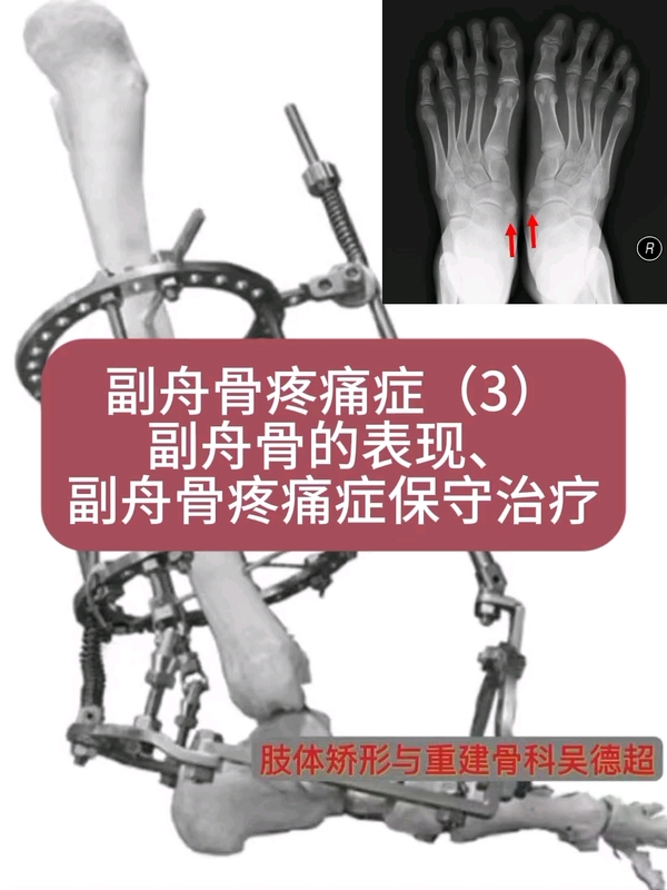 副舟骨疼痛症（3）副舟骨的表现及保守治疗＃副舟骨 ＃副舟骨疼痛 ＃医生日常 ＃脚痛 ＃保守治疗