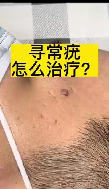 寻常疣怎么治疗?
