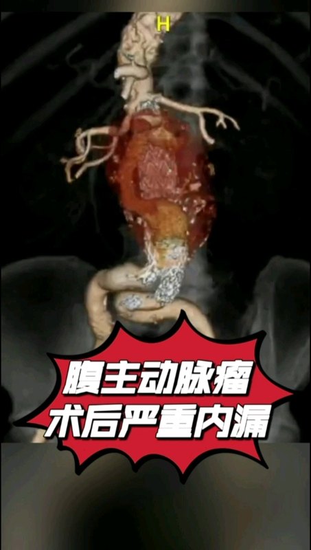 腹主动脉瘤术后严重内漏并发症