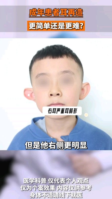 招风耳畸形矫正术