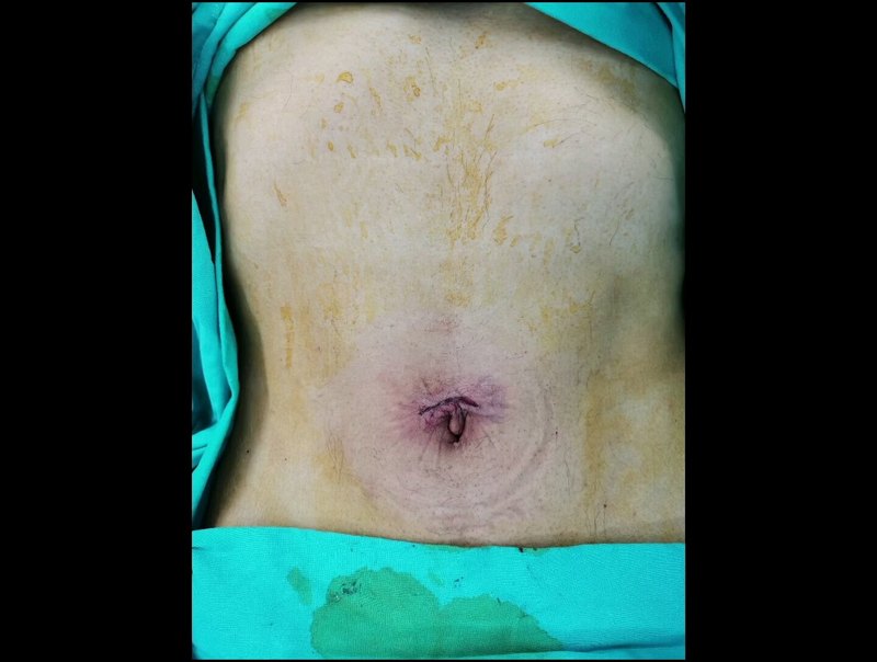 超微创：单孔腹腔镜胆囊切除