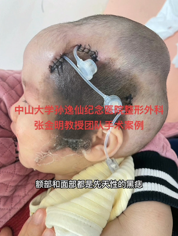 头面部先天性巨痣的扩张器治疗