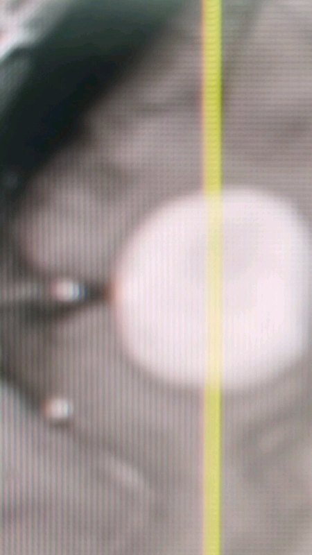 多次晕倒 检查发现颅内良性肿瘤（脑膜瘤），完全切除肿瘤…