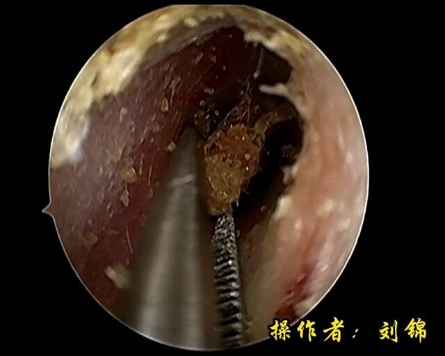 掏耳朵啦~耳镜下耵聍取出
