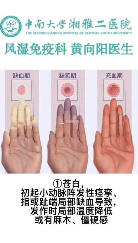 雷诺现象科普