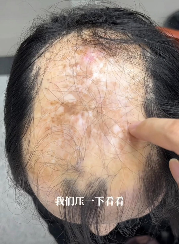 瘢痕秃发是否植发吗？