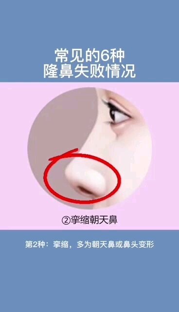 常见的6种隆鼻失败情况，不妨对照看看。