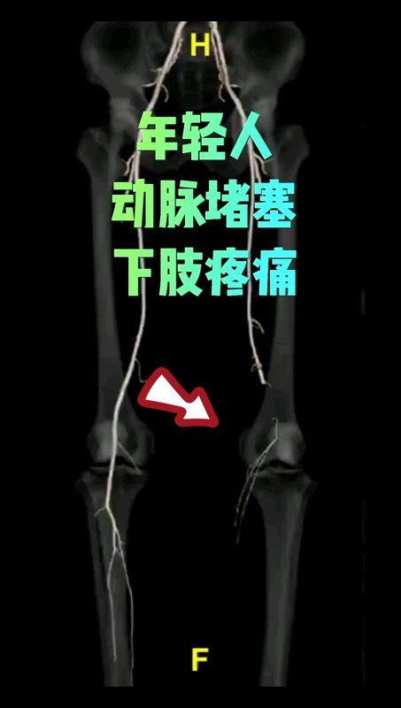 年轻人动脉堵塞下肢疼痛的原因有哪些？腘动脉陷迫综合征。
