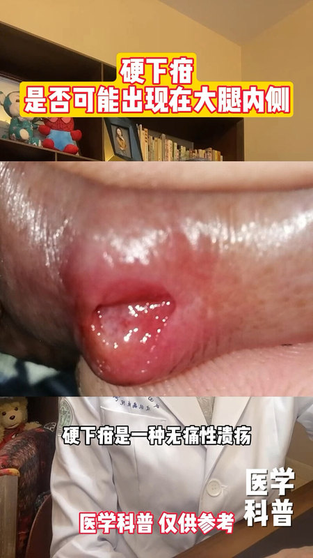 硬下疳是否可能出现在大腿内侧？