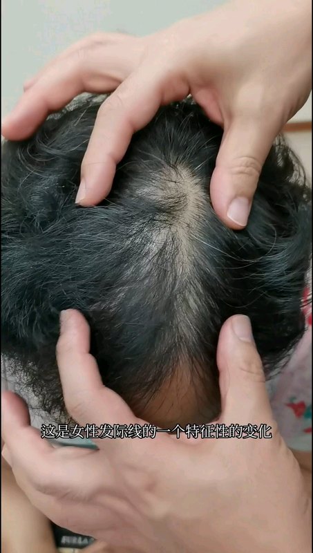 女性雄秃有什么特点？怎么治疗？