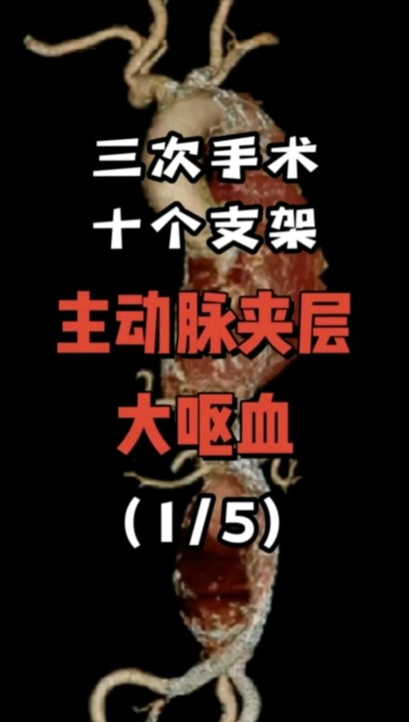 主动脉夹层历经三次手术十个支架后突发大咯血（第一集）