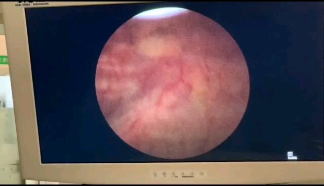 中老年血尿需警惕膀胱肿瘤