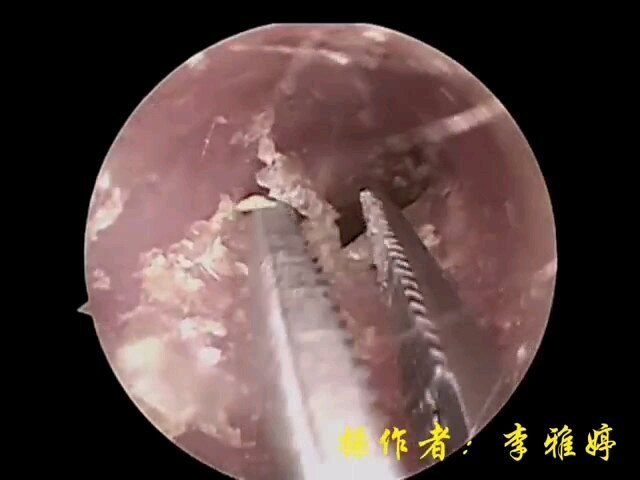 掏耳朵啦~耳内镜下耵聍取出
