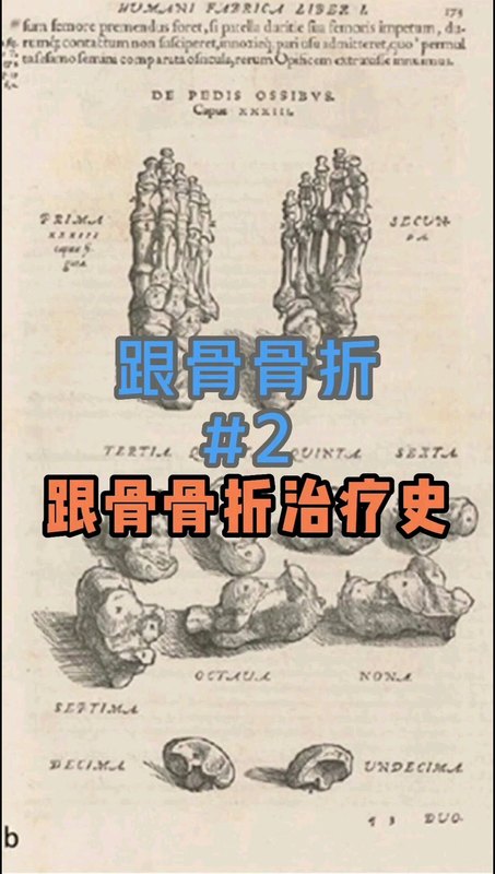 跟骨骨折治疗历史