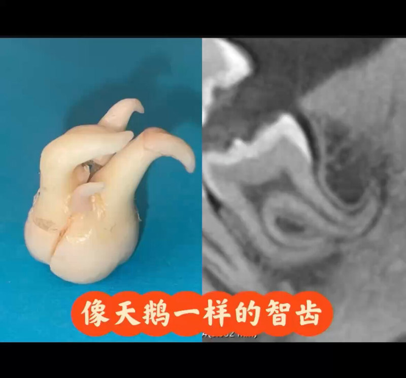像天鹅一样的弯根智齿
