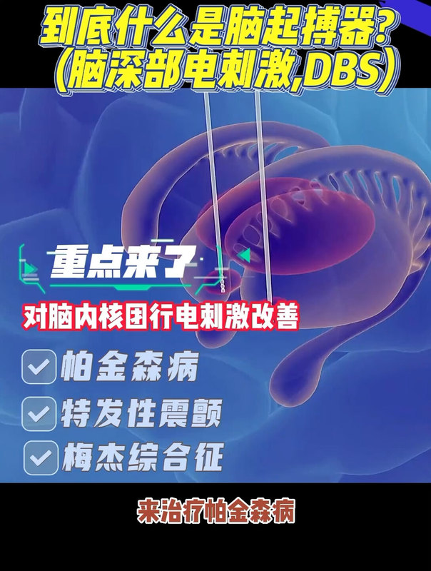 到底什么是脑起搏器（脑深部电刺激术，DBS）