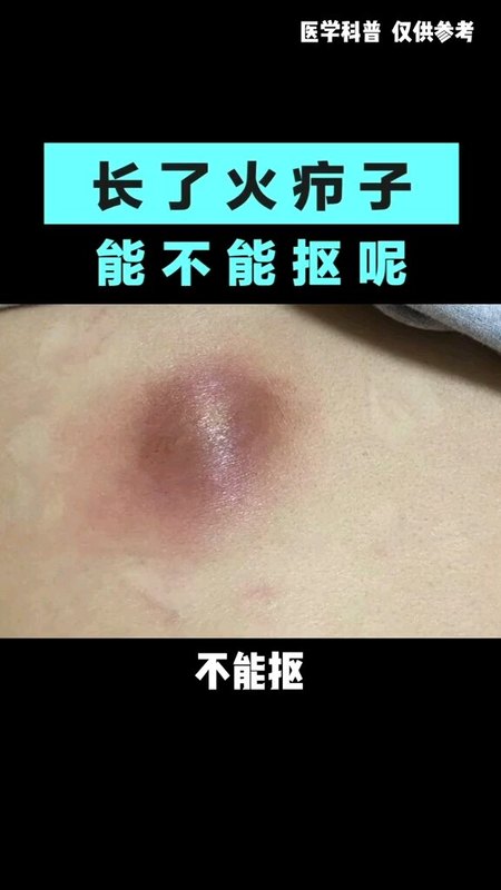 长了火疖子能不能抠？