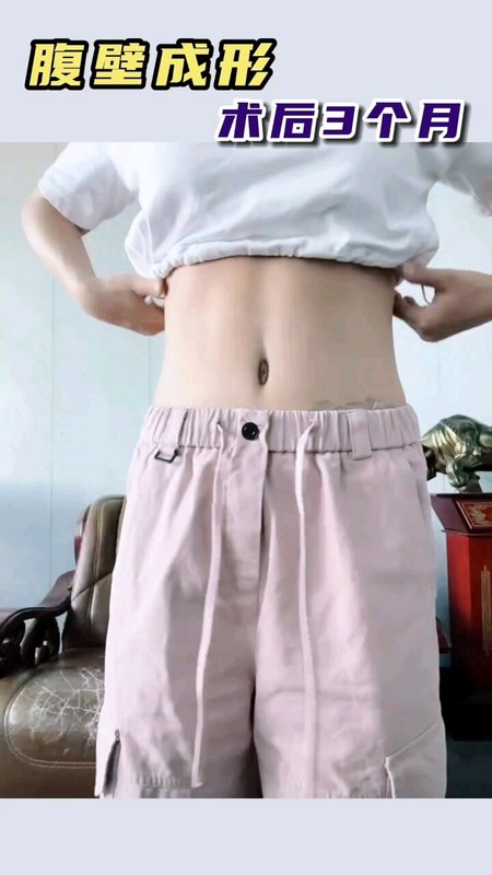 腹壁成形，术后3个月。