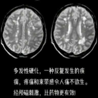 多发性硬化的后遗症怎么办？