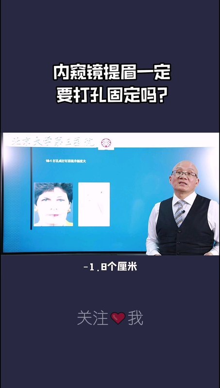 内窥镜提眉一定需要打孔固定吗？