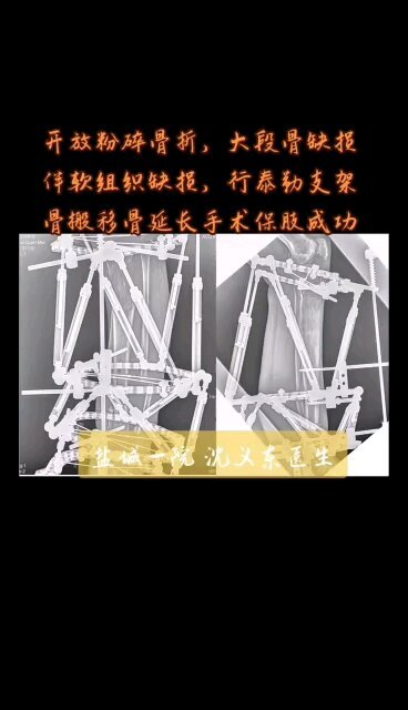 泰勒空间支架骨延长、骨搬移技术治疗开放骨折大段骨缺损，成功保肢