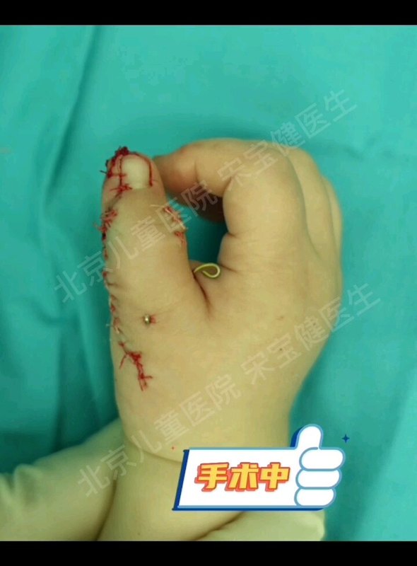 多指畸形——蟹爪样畸形手术效果怎么样？（2）
